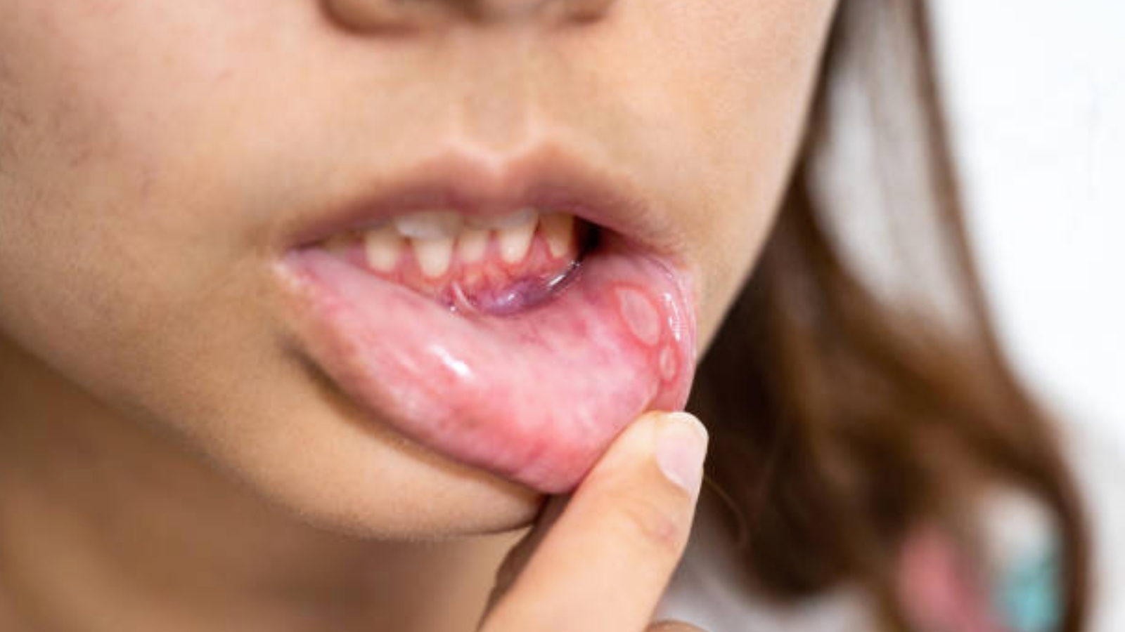 uzmani uyardi 2 haftadan uzun suren agiz yaralari ihmal edilmemeli fFHaJLi8